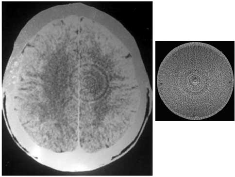 Germanic New Medicine illustration